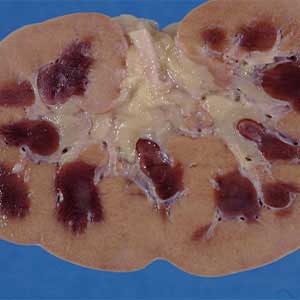 Acute Kidney Failure