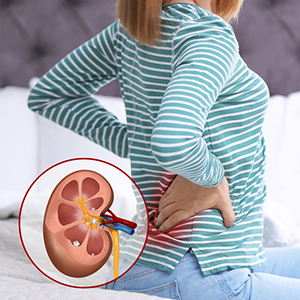 Kidney Stones Treatment in Vijayawada