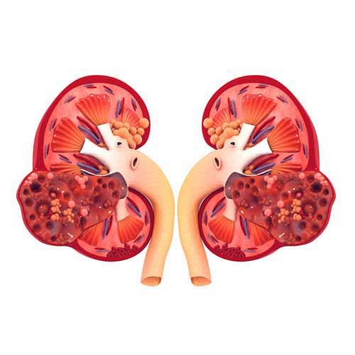 chronic kidney failure treatment in vijayawada