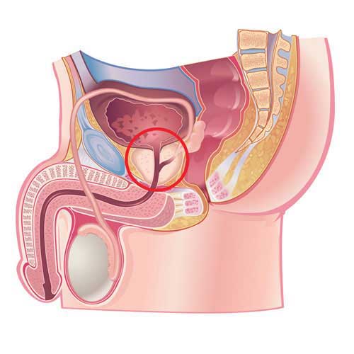 Prostate surgery in vijayawada